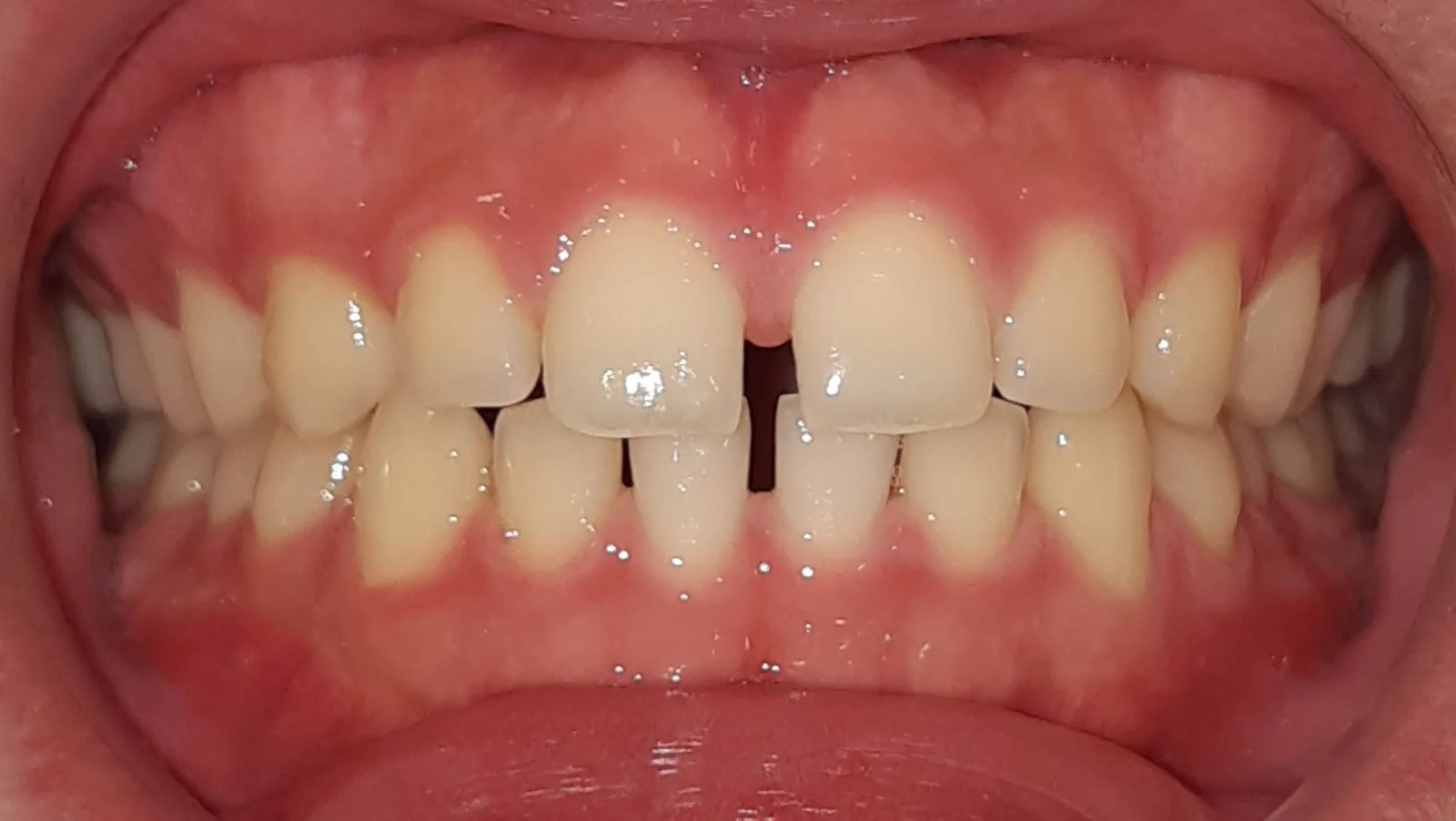Antes: diastema central