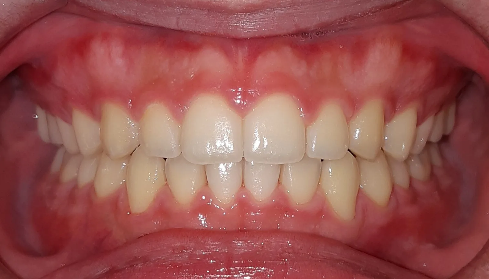 Depois: diastema corrigido