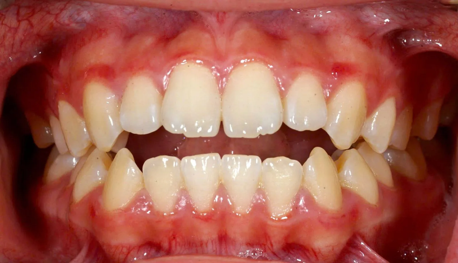 Antes: mordida aberta anterior